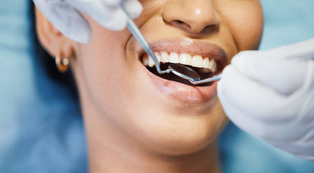 Best Emergency Wisdom Tooth Extraction in North Brooksville, FL